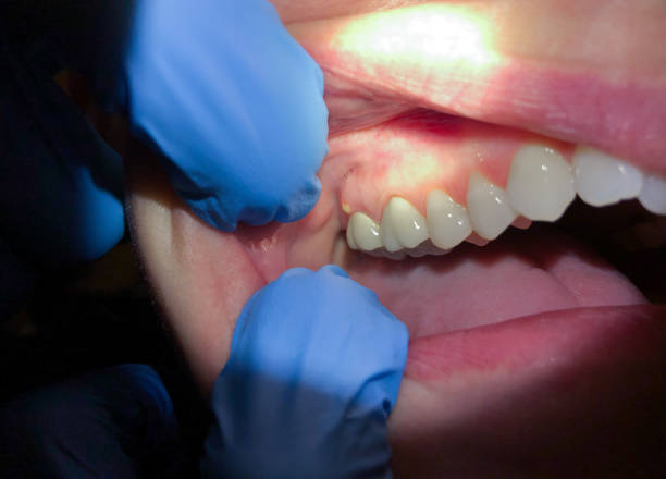Best Emergency Dental Care for Broken or Chipped Teeth in Lithopolis, OH